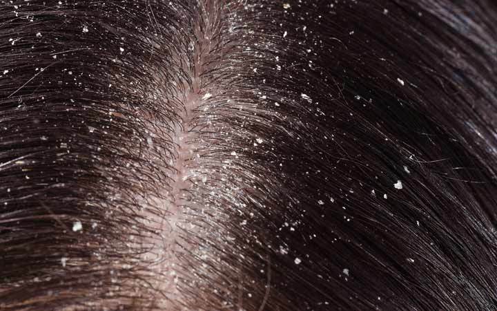 best dandruff treatment