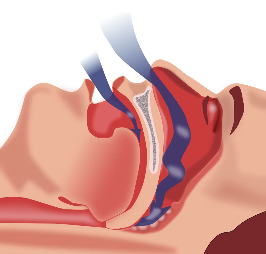 Obstructive Sleep Apnea