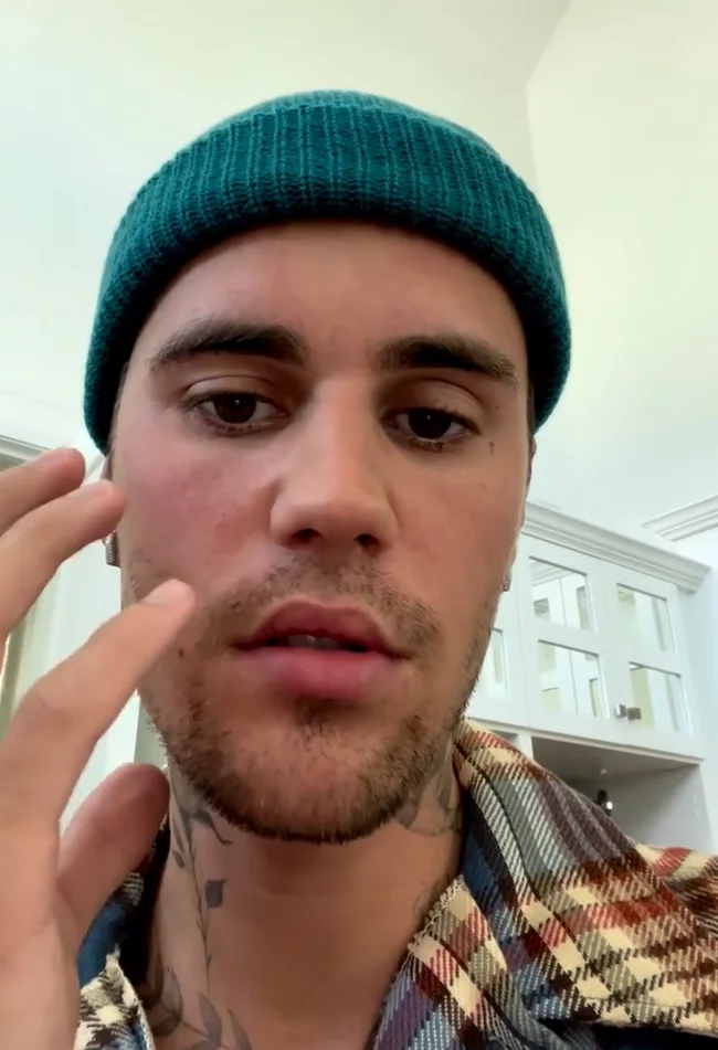 One side of Justin Bieber face has been paralysed